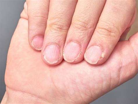 Onycholysis Nail: Causes & Prevention - RemoteDerm