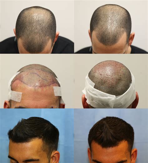 fue hair transplant after 1 month - Santa Mancuso