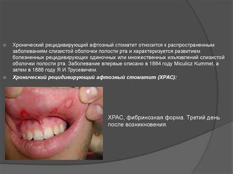 Созылмалы қайталамалы афтозды стоматит - презентация онлайн