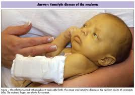 Hemolytic Disease in the Newborn Flashcards | Quizlet