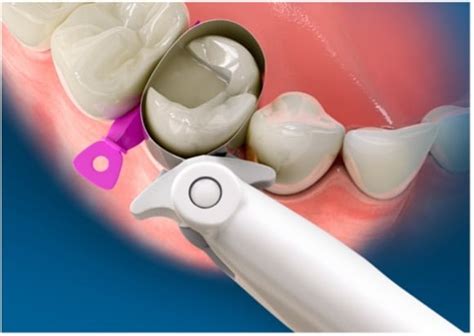 circumferential  sectional matrix bands