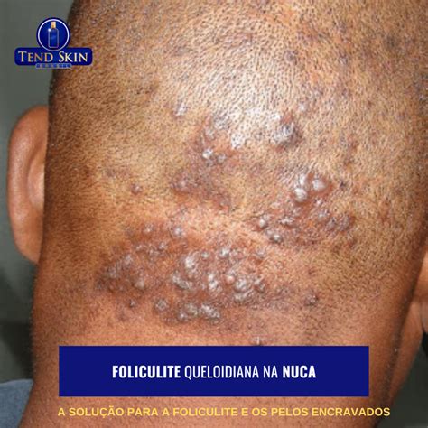 Queimação Na Nuca O Que Pode Ser - Foliculite Queloidiana Da Nuca Fotos - RETOEDU