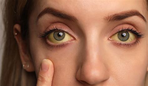 Occhi gialli: quale può essere la causa? - Vision Future