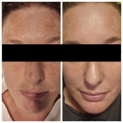 Before & After Skincare Results | La Clinica