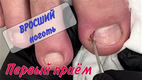 💥Вросший ноготь / 💥врастающий ноготь / 📍подолог Москва - YouTube