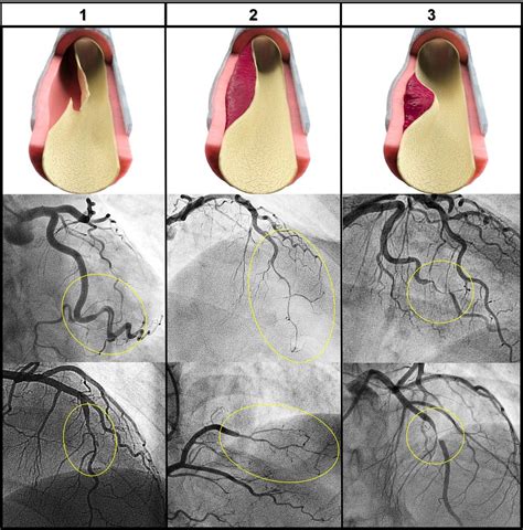Spontaneous coronary artery dissection: contemporary aspects of ...