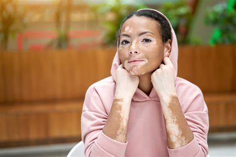 Vitiligo: Ursachen, Symptome & Behandlungsmöglichkeiten