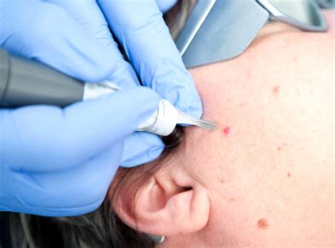 Красные родинки на теле: причины, лечение и удаление родинок - Science ...