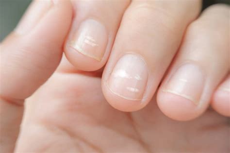 Manchinhas Brancas Nas Unhas - Manchas brancas nas unhas: causas e como tratar em casa