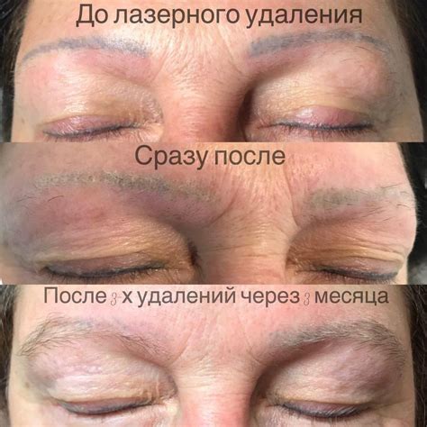 @Studioliontattootverskaya Удаление старого татуажа бровей лазером ...