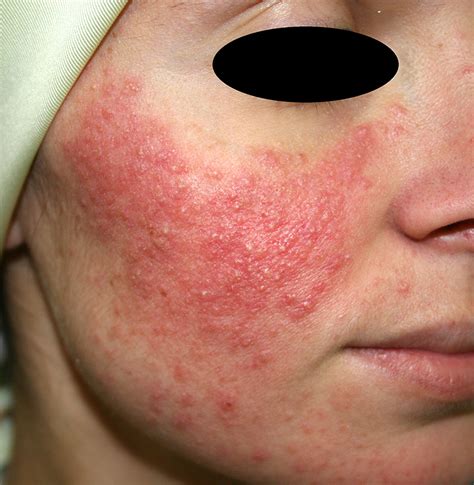 acne rosacea - DrBeckmann