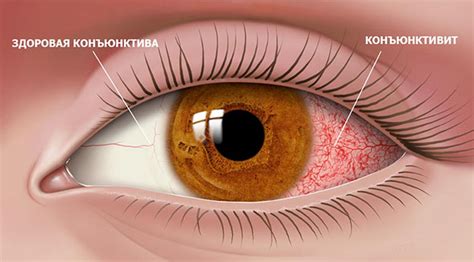 Конъюнктивит у ребенка, лечение и профилактика