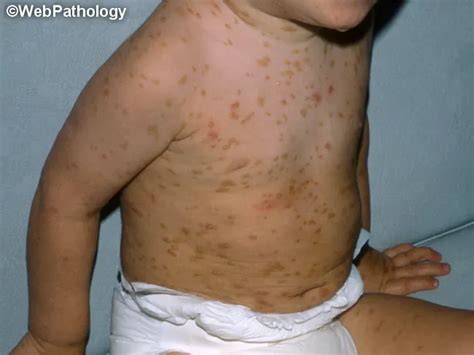 Mastocytosis : Epidemiology