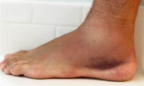 What Does Swelling In The Left Ankle Mean at John Sloan blog
