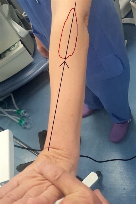 Epicondylite du coude ou tennis elbow | Tendinite coude | Pr Eric Roulot
