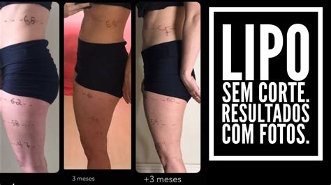 Como Funciona A Lipo Sem Corte - Lipo sem corte- minha experiência com fotos - YouTube