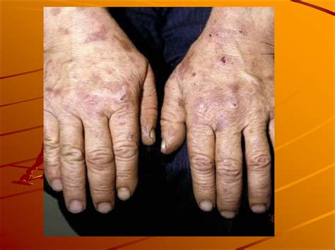 Porphyria Cutanea Tarda. Порфирия кожная медленная - презентация онлайн