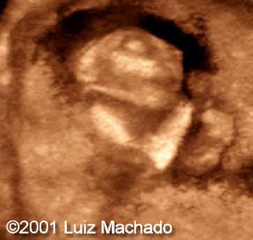 📃 Anencephaly, 3D