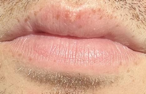 White spot on lip : r/DermatologyQuestions