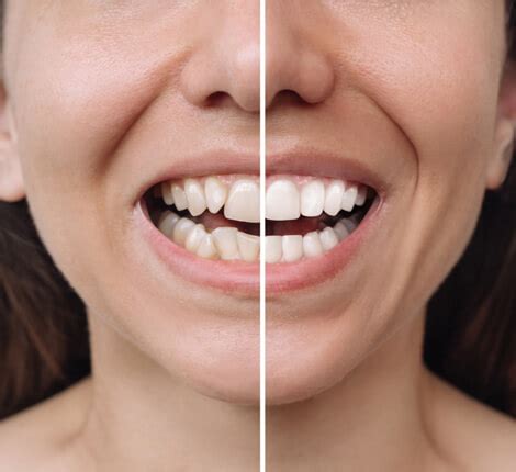 Dentite | Medicinal Foods