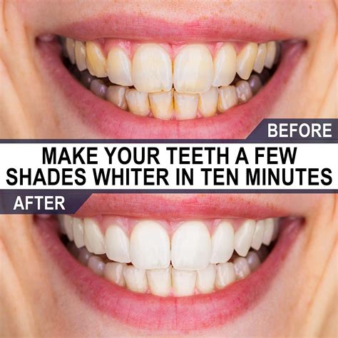 Tooth Whitening Supplies at Steve Stults blog