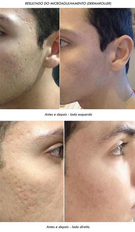 Como Fica O Rosto Depois Do Microagulhamento - Microagulhamento Cicatriz Antes E Depois - NAZAEDU
