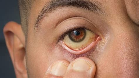 Ayurvedic Treatment For Jaundice | Karma Ayurveda