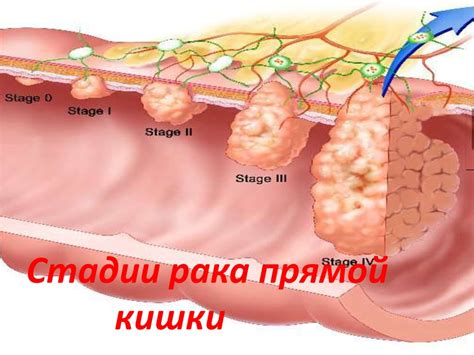 Рак прямой кишки - презентация онлайн