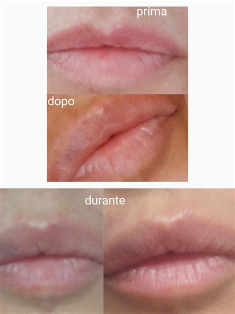 Filler labbra, labbro superiore - Filler - Guidaestetica.it