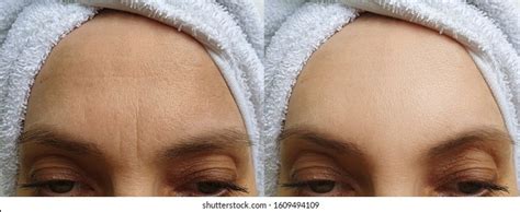 7,032 Anti Ageing Before After Images, Stock Photos & Vectors | Shutterstock