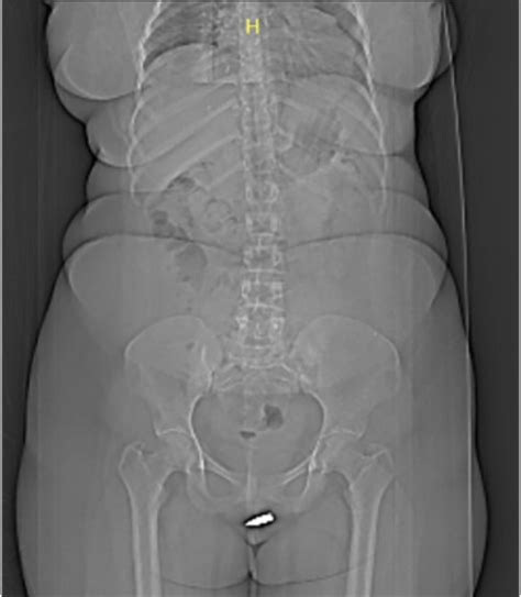 Stray bullet lodged in Somalian woman's clitoris : r/WTF