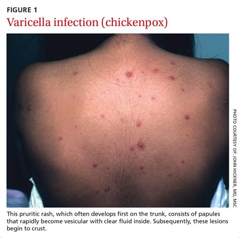 images  viral exanthem pics myweb