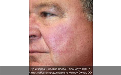 Фото до та після процедур фотоомолодження BBL, результати від Sciton