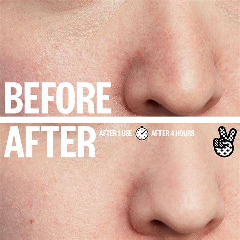 Unbelievable Blackhead Removal 2024: Results So Good, It's Viral! Image 6