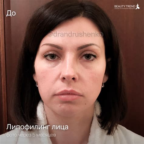 Работа доктора Андрющенко О.А. - Липофилинг лица, 2А