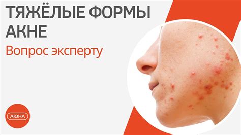 Тяжелые формы акне: вопрос эксперту - YouTube