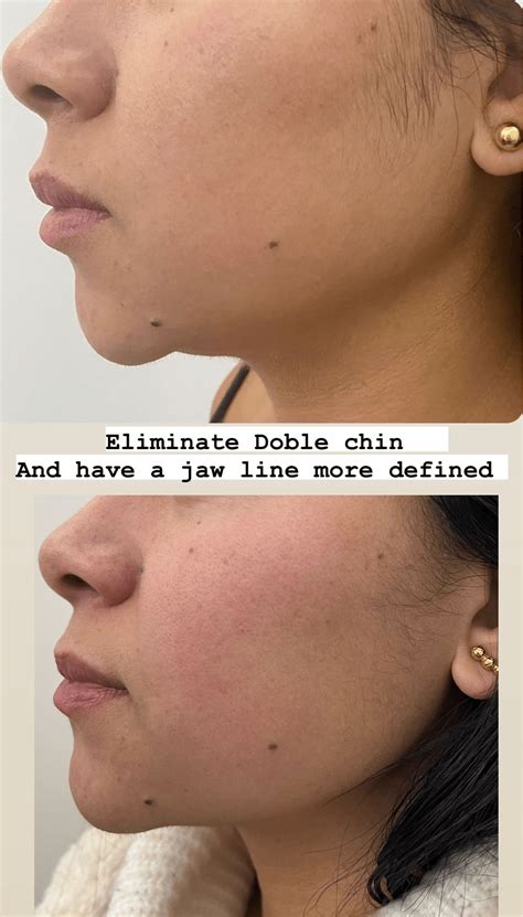 FAT REMOVAL - Clinique Grace