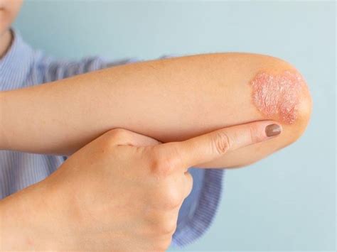 eczema treatment  dr padmaja skin hair clinic pragathi nagar