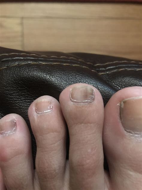 Why Do Toenails Turn White From Nail Polish at Colin Fleming blog