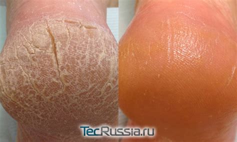 Трещины на пятках ног – как избавиться? Причины появления, лечение, фото