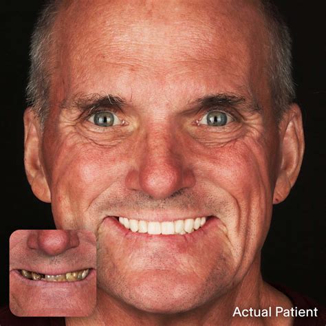 Doctors Implants – Full Mouth Dental Implants