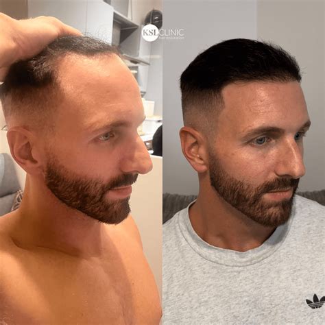 How to Fix a Pushed Back Hairline (Permanently!) - KSL Clinic