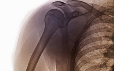 Bursae: Anatomy, Function, and Treatment