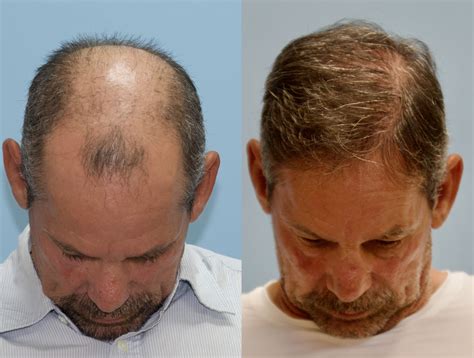 FUE Hair Transplant Archives - Carolina Hair Surgery