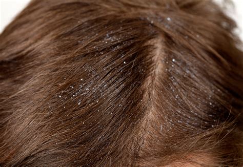 Why Is My Scalp So Itchy? - 10 Ways to Treat a Dry, Itchy Scalp