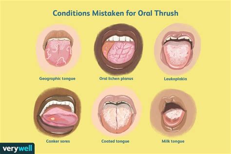 Normal Tongue vs. Oral Thrush and Other Conditions