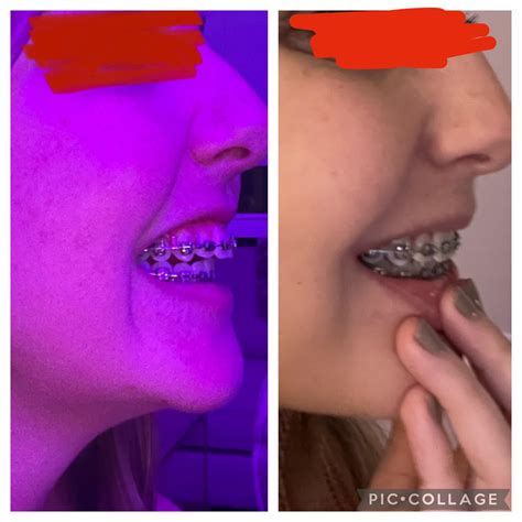 Are Braces Necessary For Jaw Surgery at James Marts blog