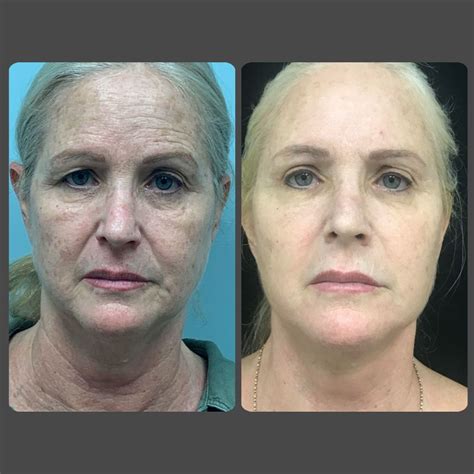 facial surgery rejuvenation enhancing  youthful appearance