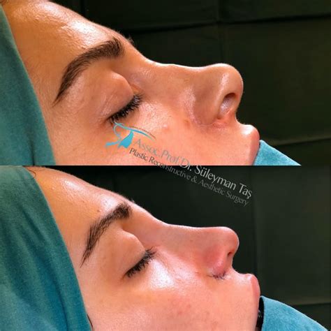 thick skin bulbous tip rhinoplasty assoc prof dr suleyman tas