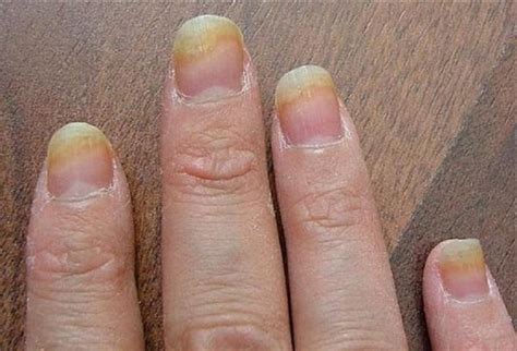 Фото и симптомы грибка ногтей на руках: признаки, как выглядит